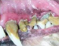 Severe periodontal disease